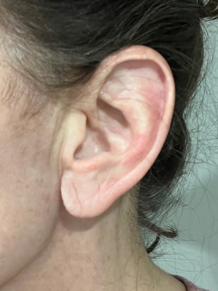 Earlobe reduction.before