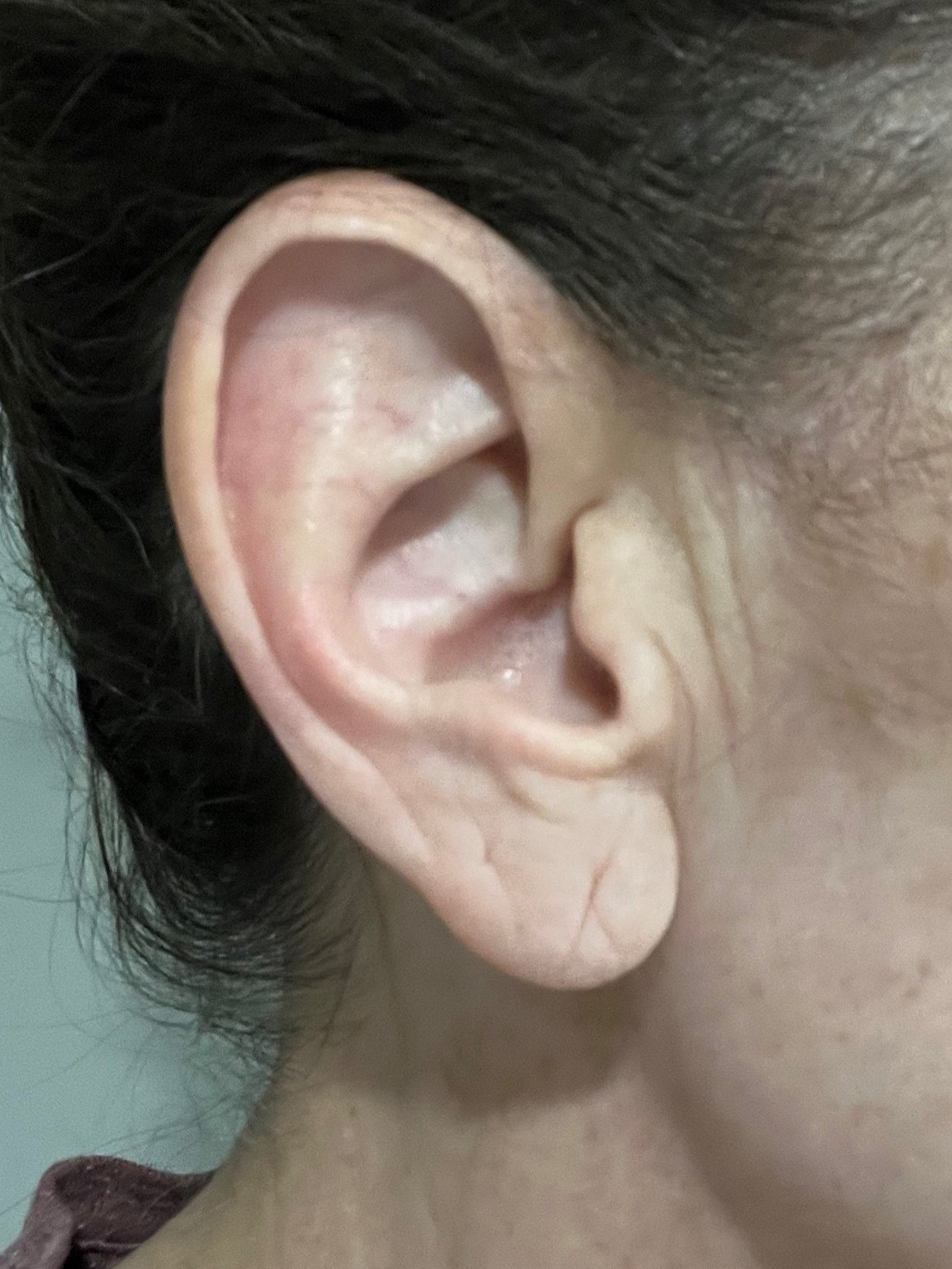 Earlobe reduction.before