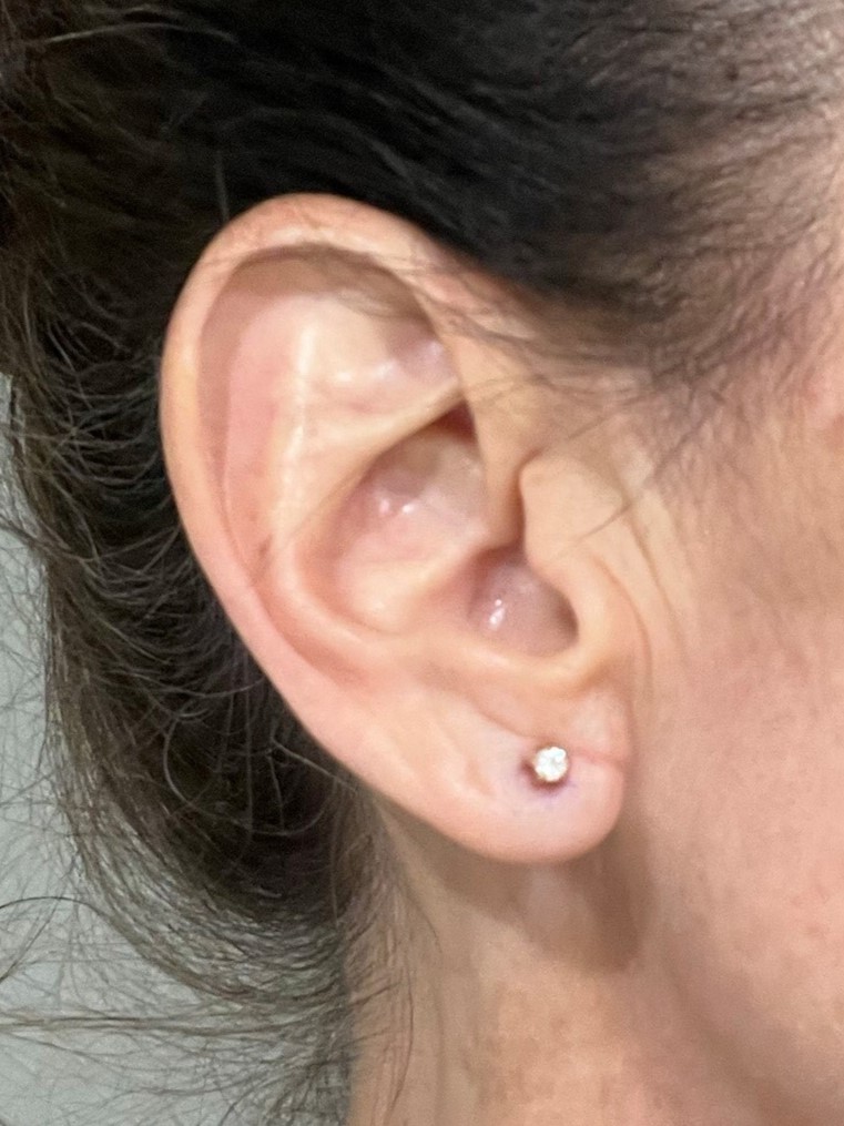 Earlobe reduction.before