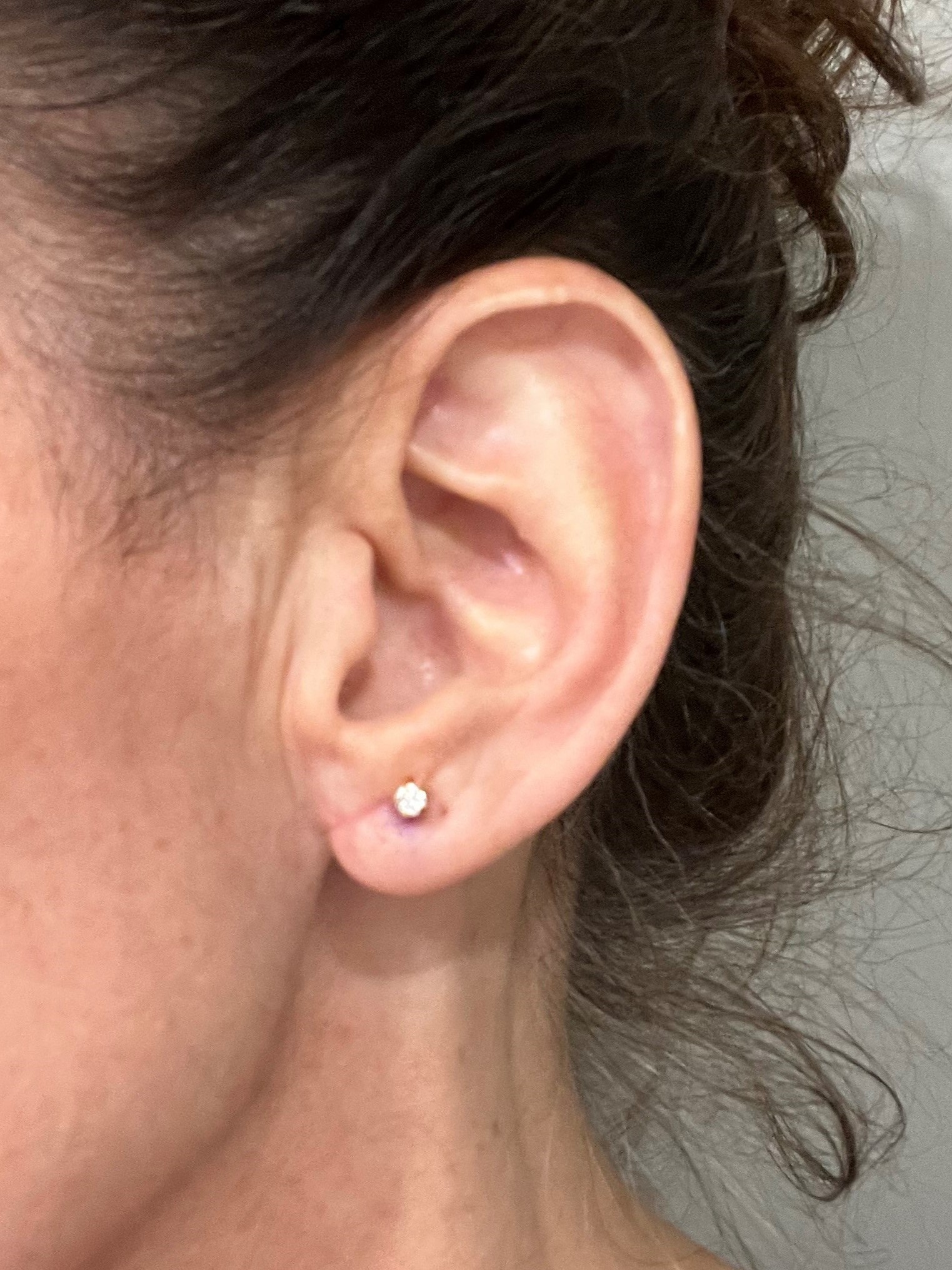 Earlobe reduction.before
