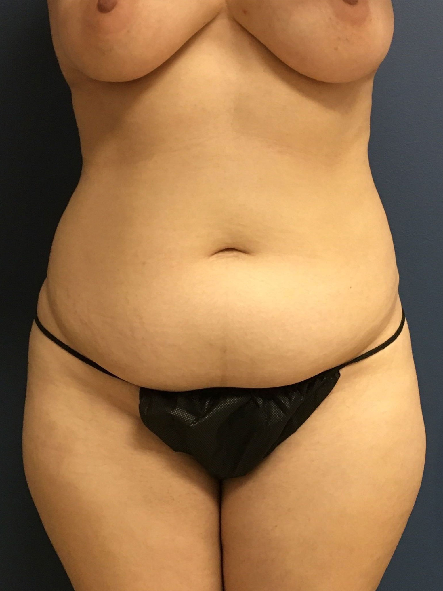 4.2.2025.EAK.Abd.w.lipo.Before_1