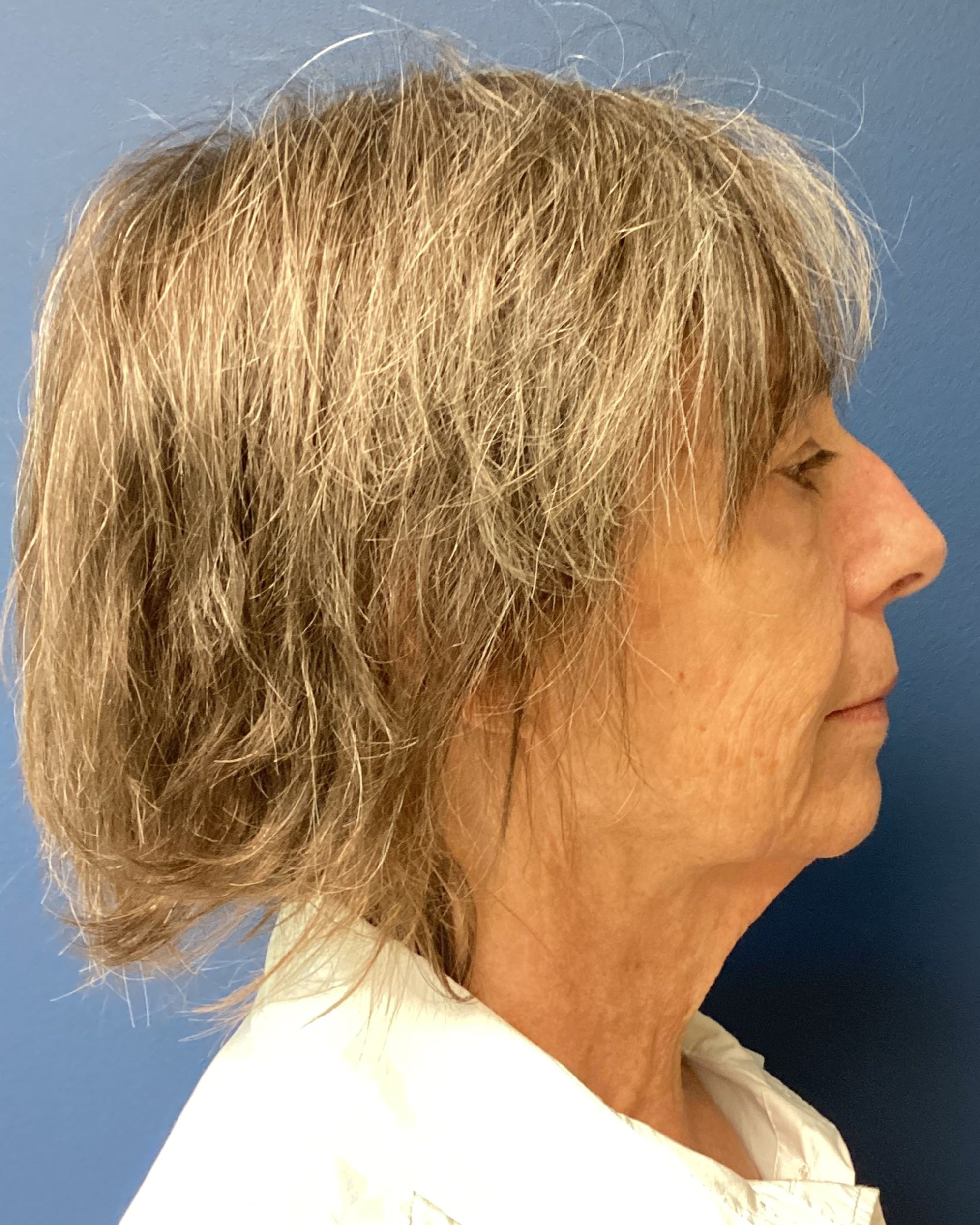 JDS_RHINO_BP_10.28.24_BEFORE5