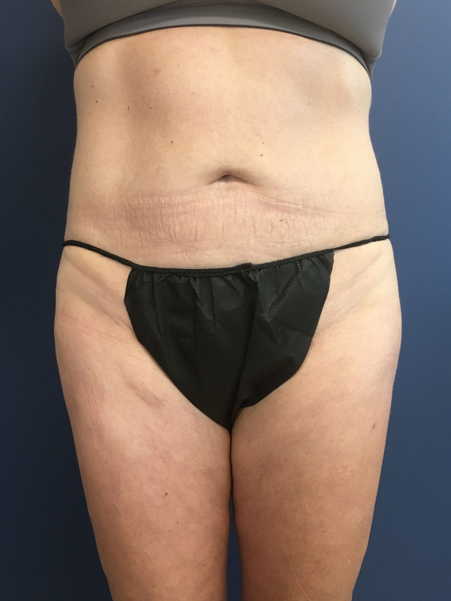MWM_Liposuction_4.13.23_After1