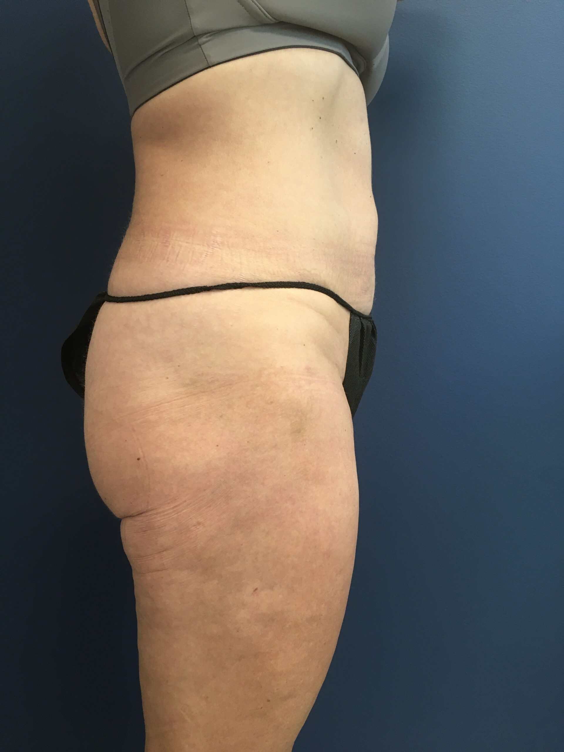 MWM_Liposuction_4.13.23_After2