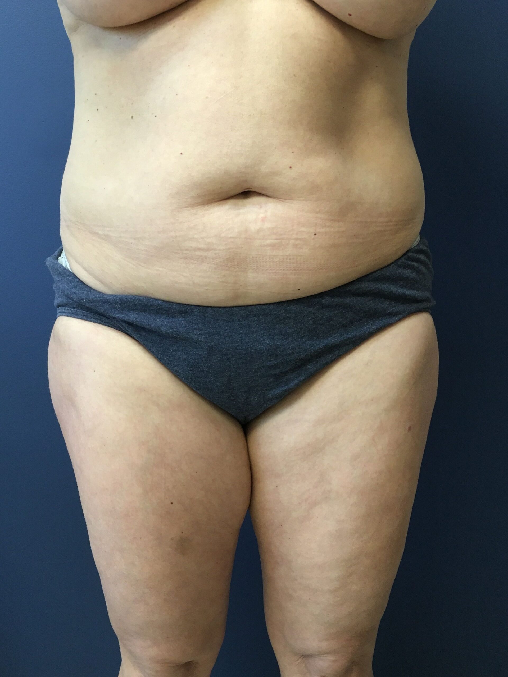 MWM_Liposuction_4.13.23_Before1