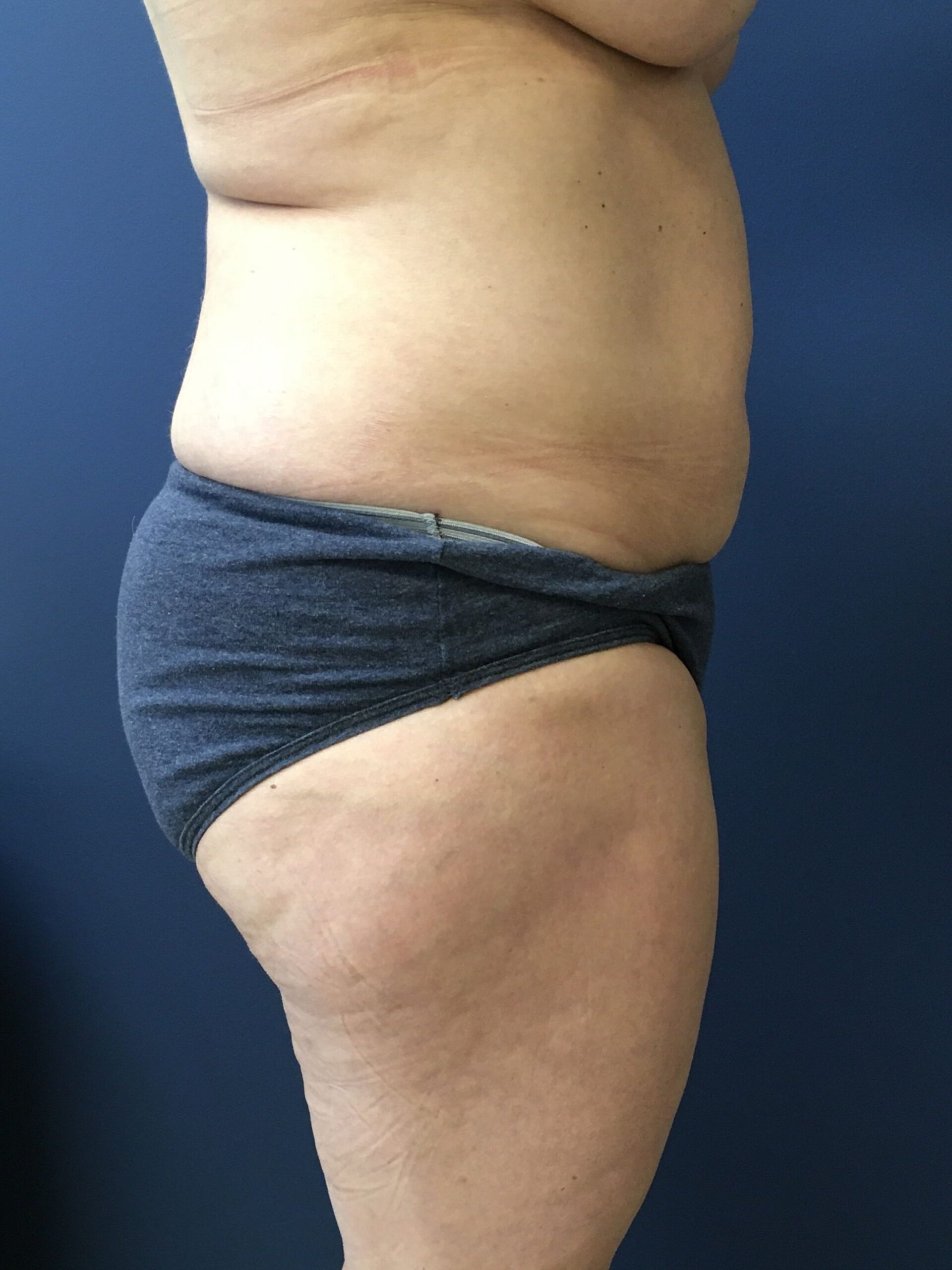 MWM_Liposuction_4.13.23_Before2