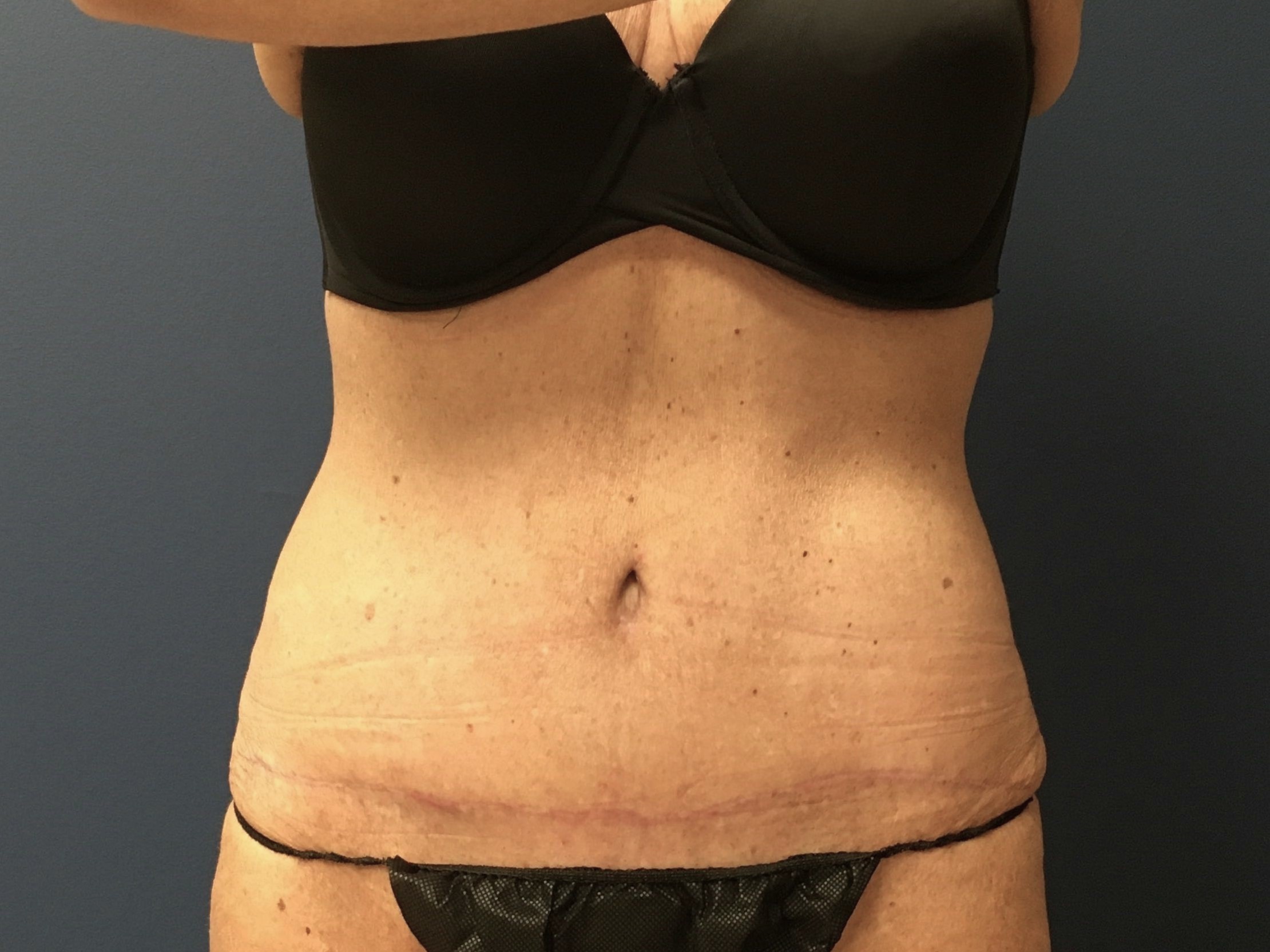 SLY- ABD sx 6.3.25 after 1