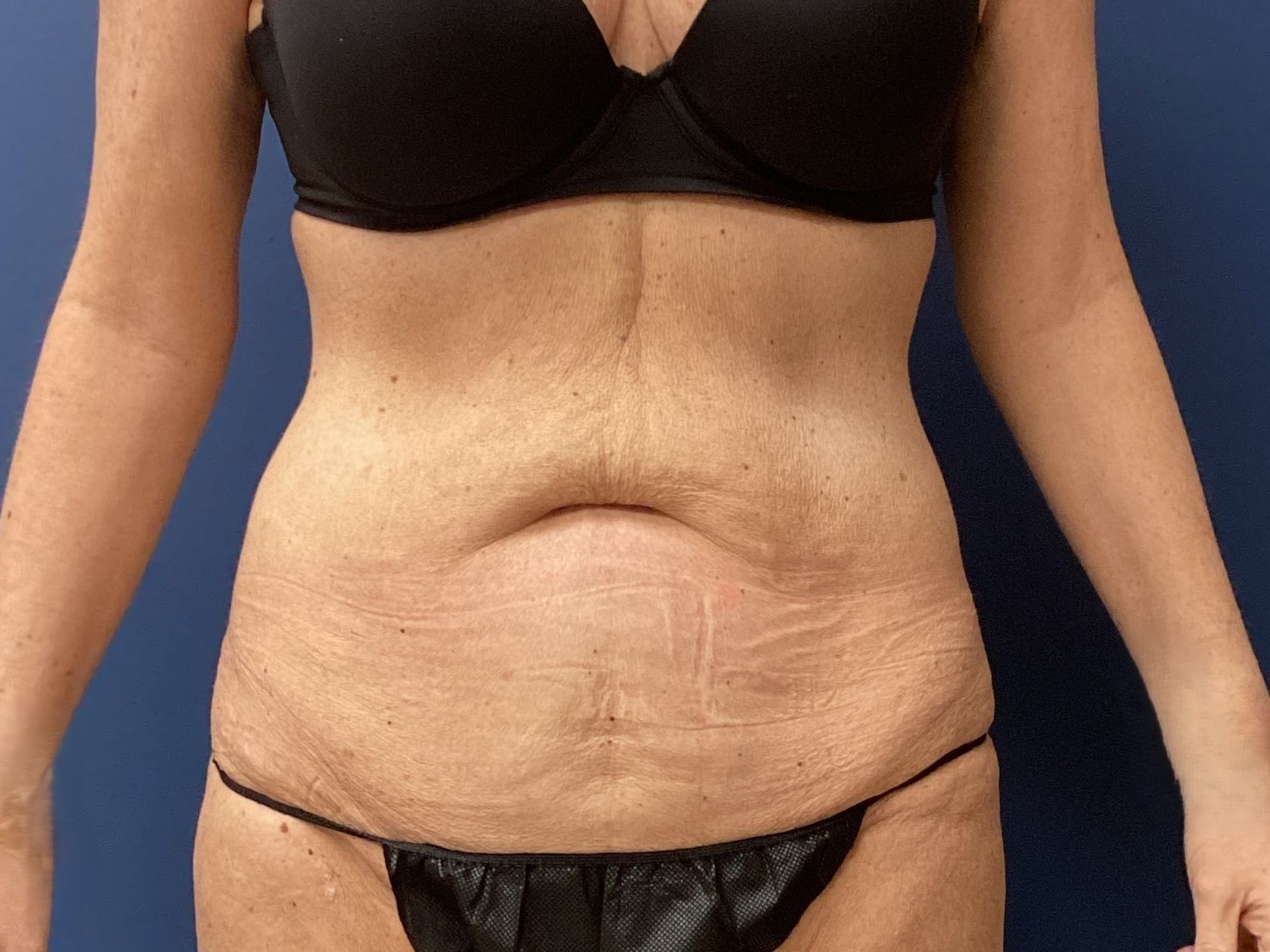 SLY- ABD sx 6.3.25 before 1