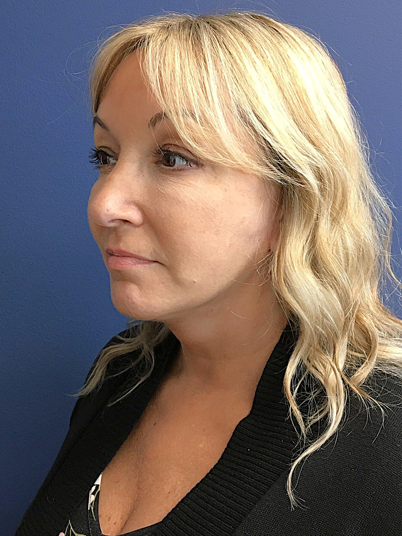 07.31.25.EAK.Neckfacelift_After.1