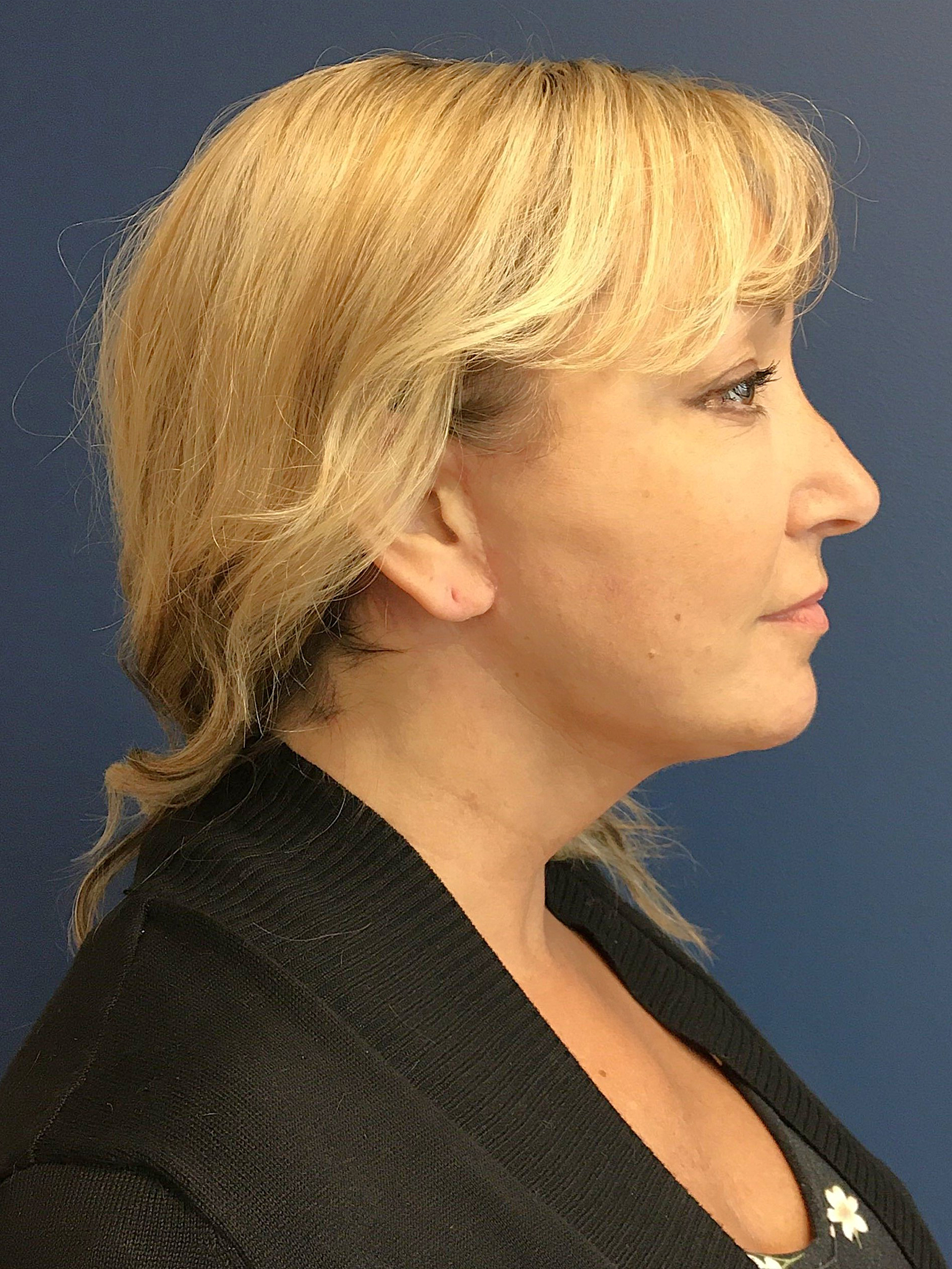 07.31.25.EAK.Neckfacelift_After.2