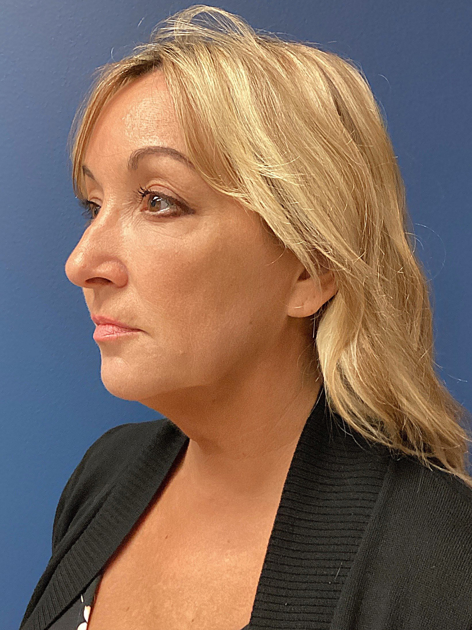 07.31.25.EAK.Neckfacelift_Before.1