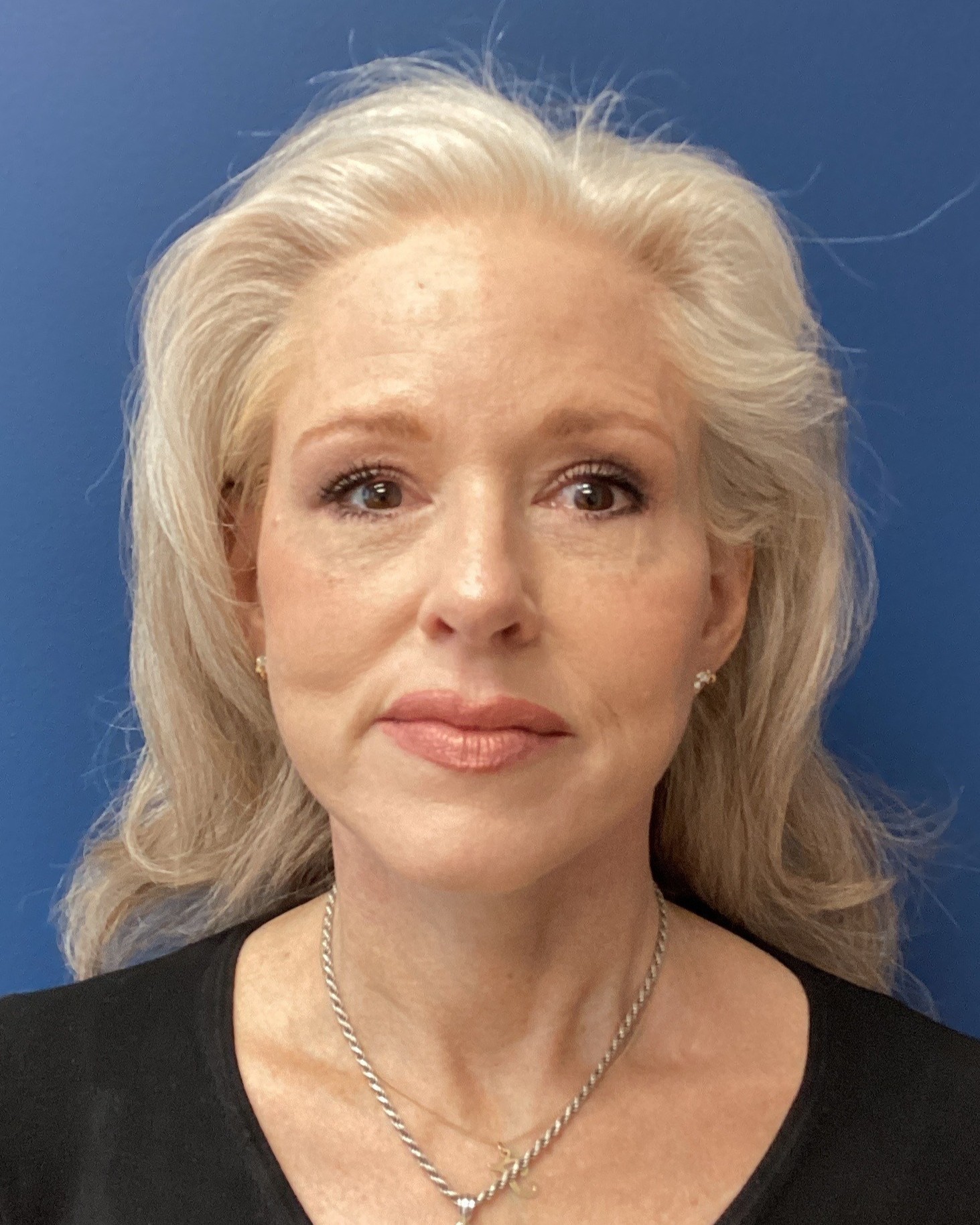 JER_RHYTIDECTOMY PT 17 After 1