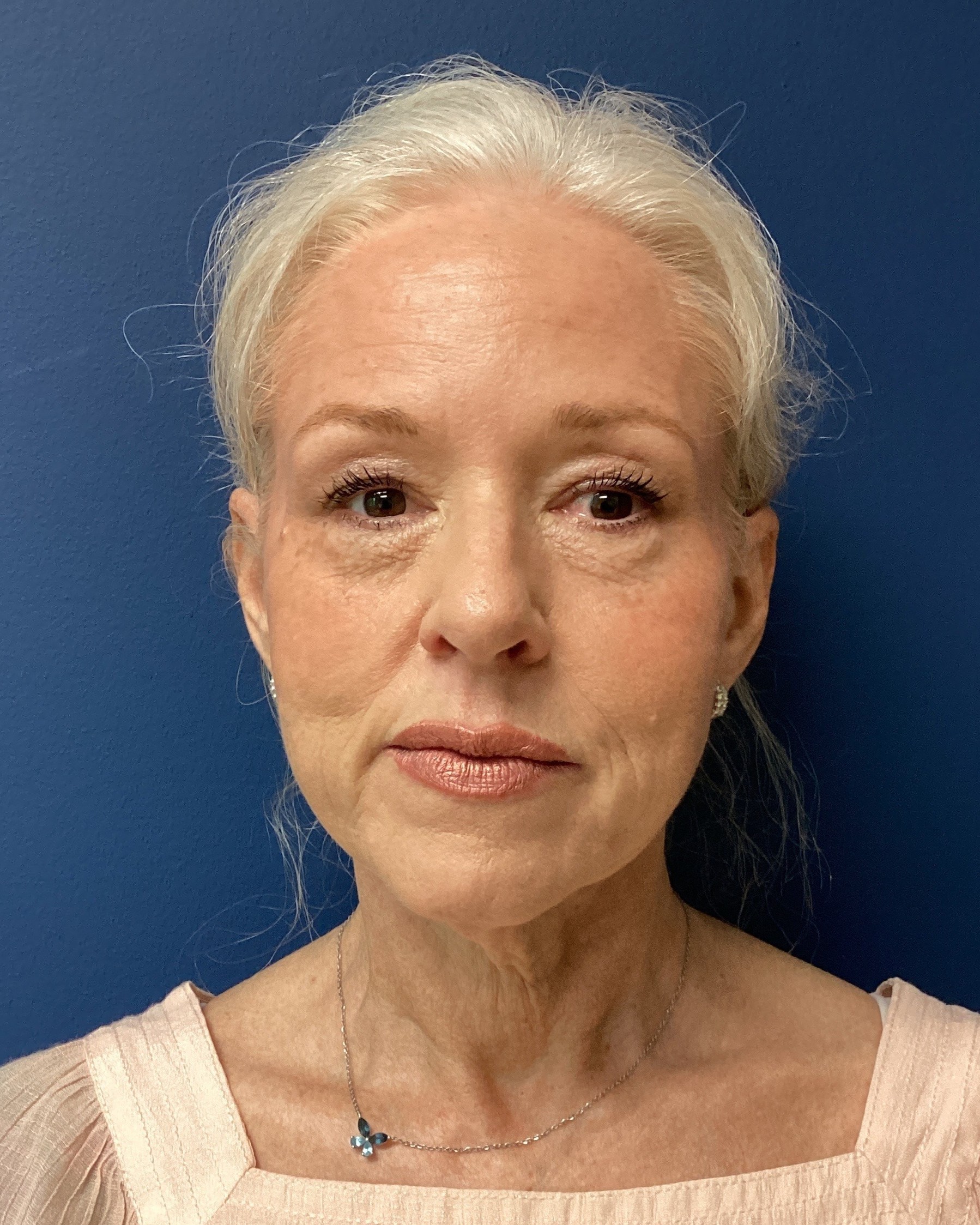 JER_RHYTIDECTOMY PT 17 BEFORE 1