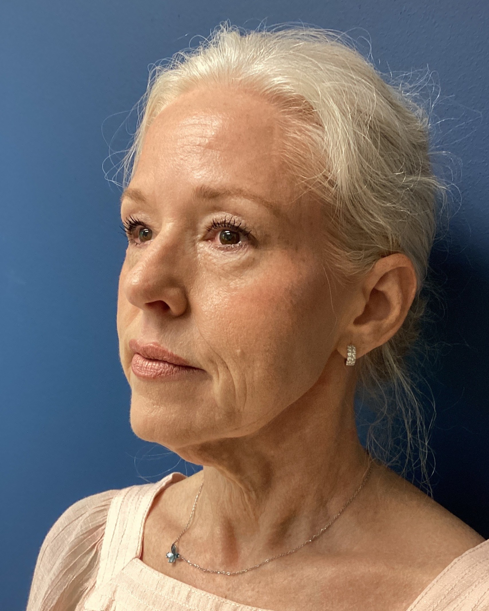 JER_RHYTIDECTOMY Patient 17 Before 2