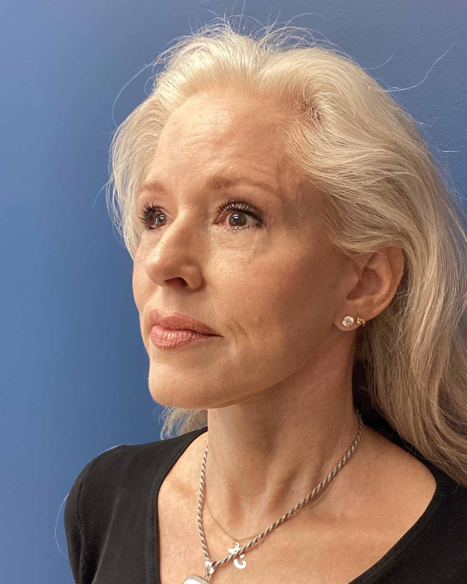 JER_RHYTIDECTOMY_Patient 17 After 2