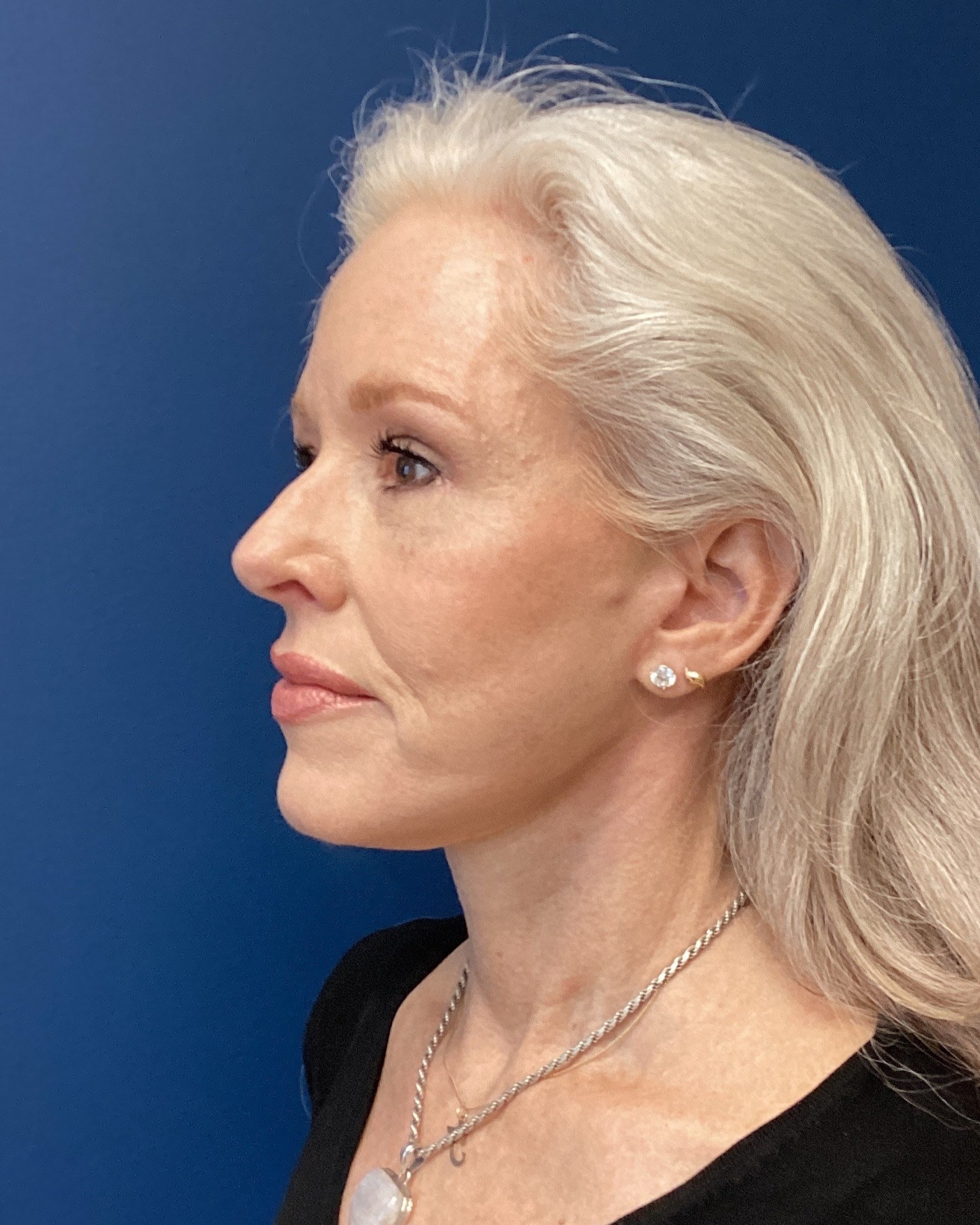 JER_RHYTIDECTOMY_Patient 17 After 3