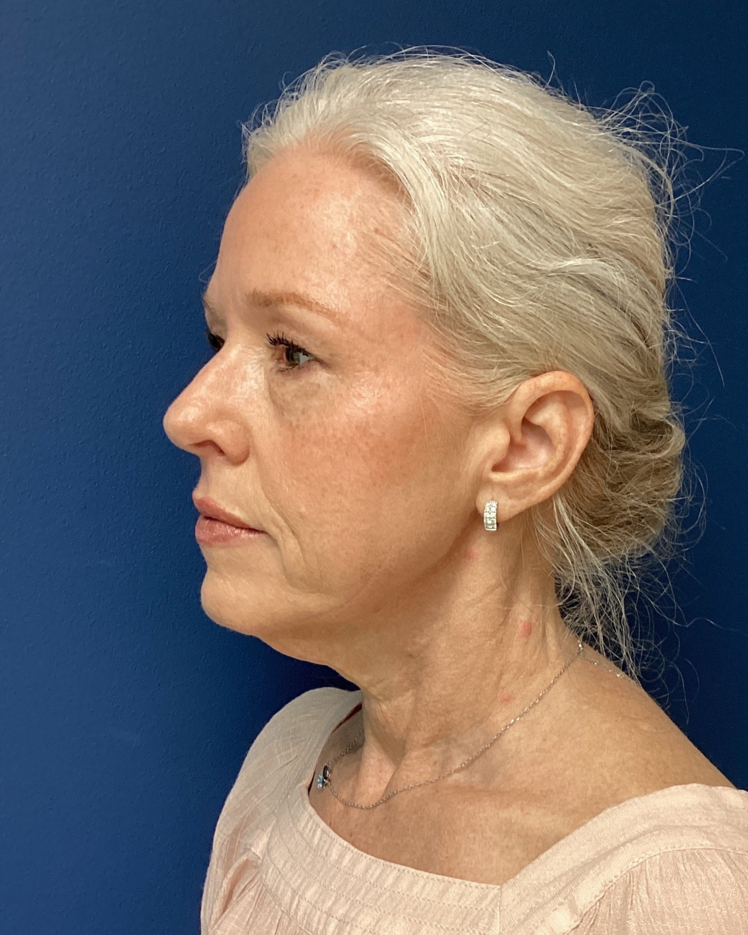 JER_RHYTIDECTOMY_Patient 17 Before 3