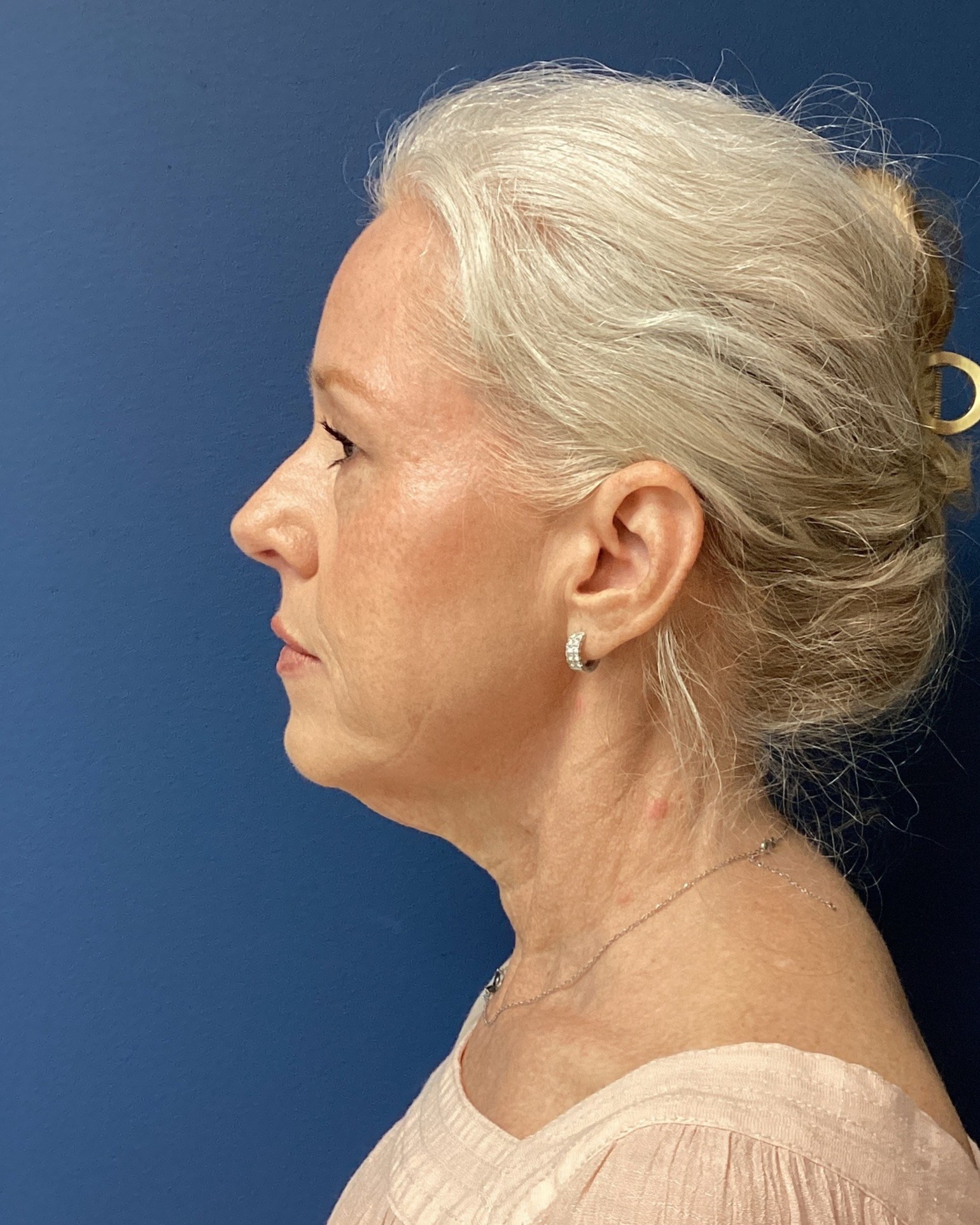 JER_RHYTIDECTOMY_Patient 17 Before 4