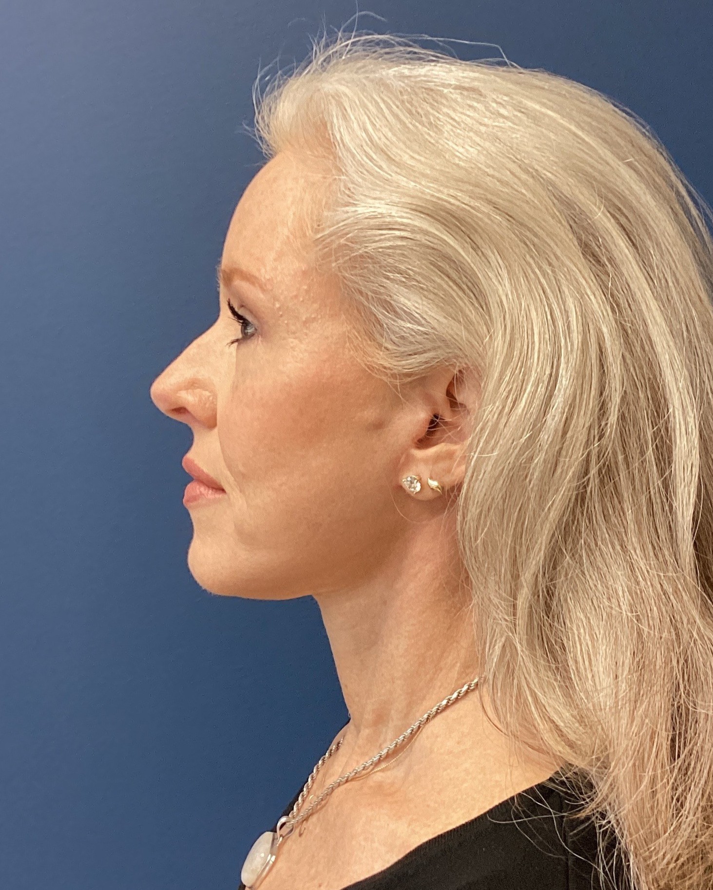 JER_RHYTIDECTOMY_Patietn 17 After 4